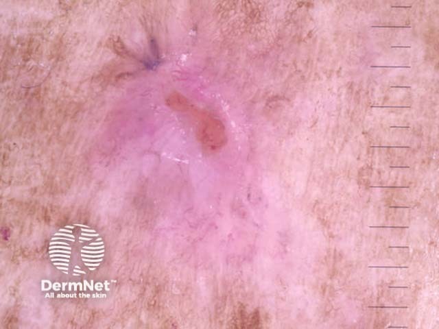 Nodular basal cell carcinoma, nonpolarised dermoscopy view