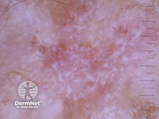 Nodular basal cell carcinoma dermoscopy