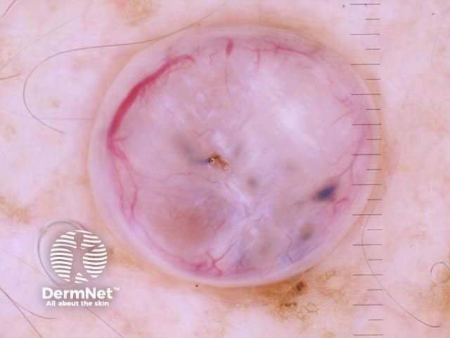 Polarised dermoscopy of a nodular basal cell carcinoma presenting as an exophytic polyp