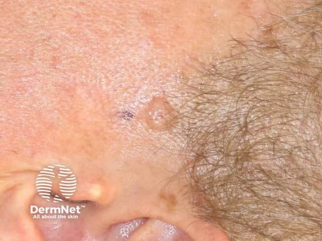 Nodular basal cell carcinoma