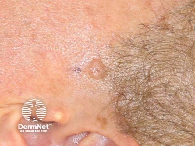 Nodular basal cell carcinoma