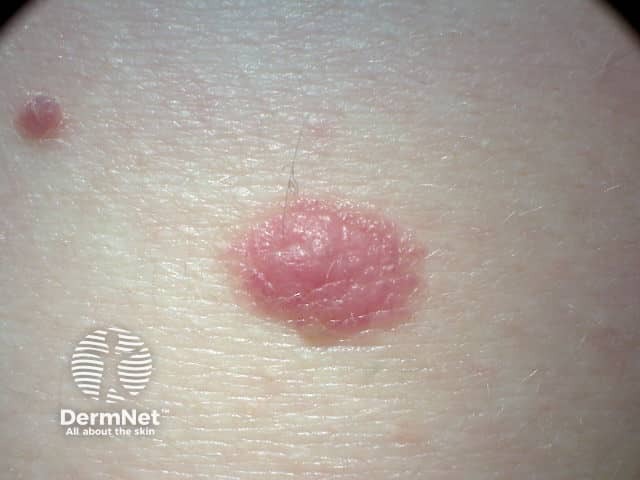 Pink dermal naevus