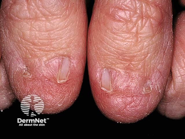 Nail patella syndrome