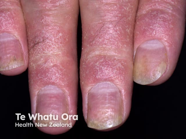 Nail psoriasis