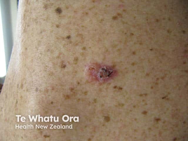 Nodular basal cell carcinoma, arm