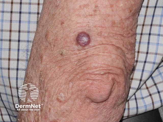 Nodular basal cell carcinoma, arm