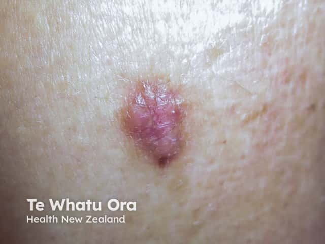 Nodular basal cell carcinoma, arm