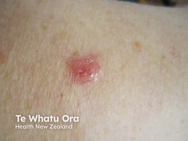 Nodular basal cell carcinoma, arm