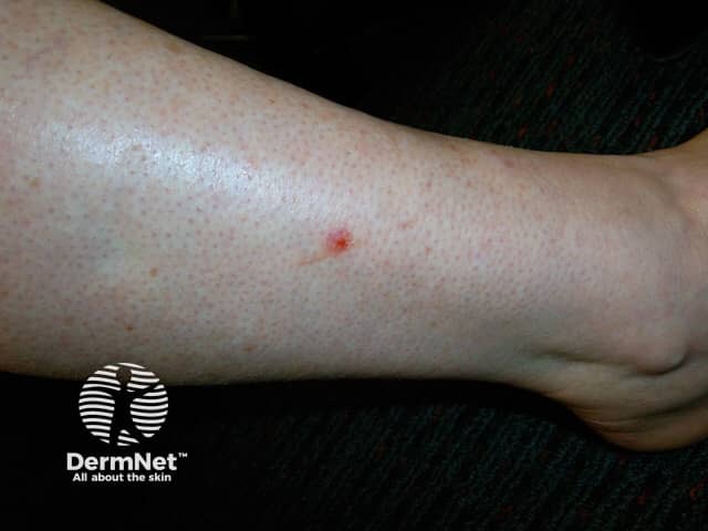 Nodular basal cell carcinoma, leg