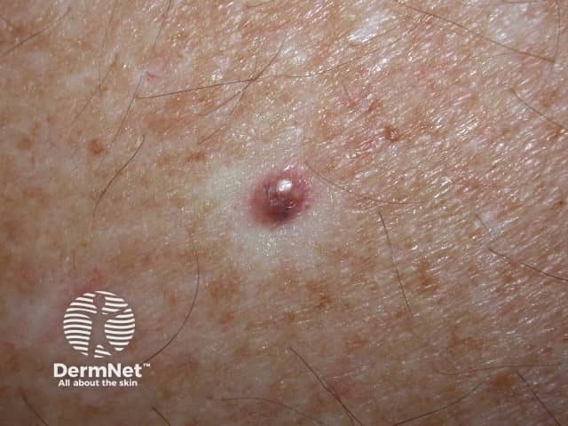 Nodular basal cell carcinoma, leg