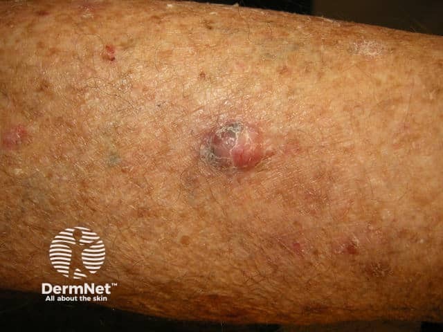 Nodular basal cell carcinoma, leg