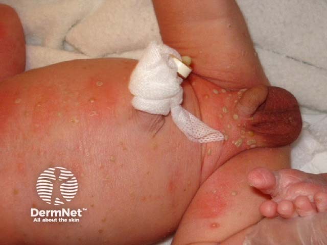 Neonatal pustular melanosis