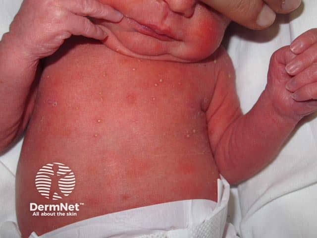 Neonatal pustular melanosis