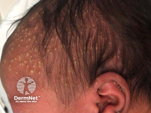 Transient neonatal pustular melanosis