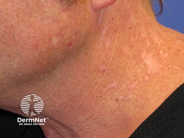 Brachioradial pruritus, scarring on the neck