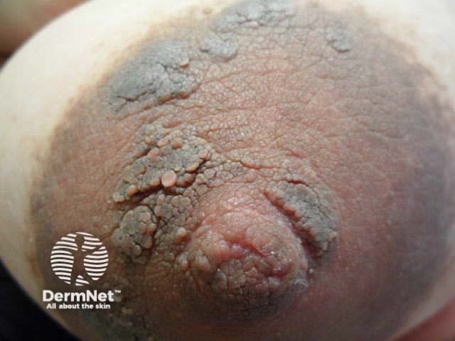 Hyperkeratosis of the nipple