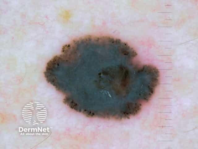 Dermoscopy of nodular melanoma Breslow 0.8 mm