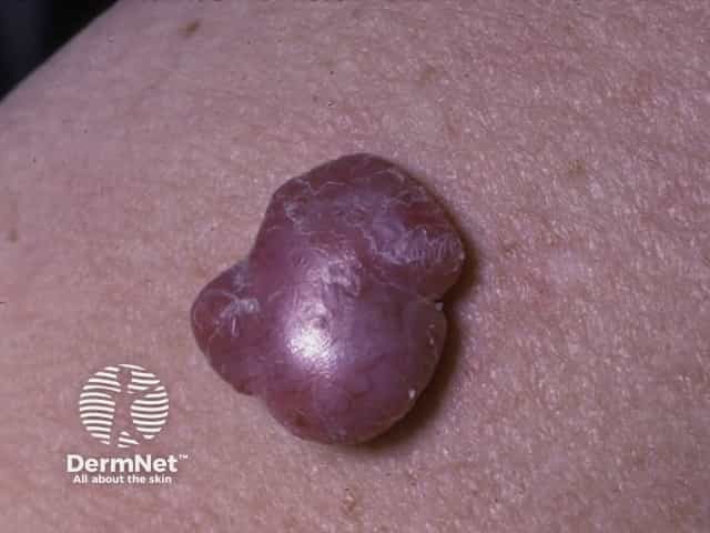 Nodular melanoma