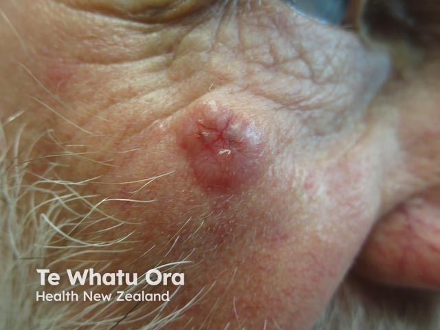 Nodular basal cell carcinoma