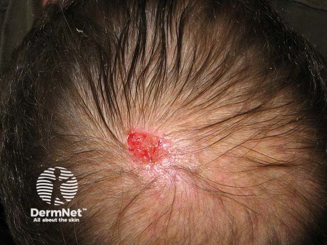 Nodular basal cell carcinoma