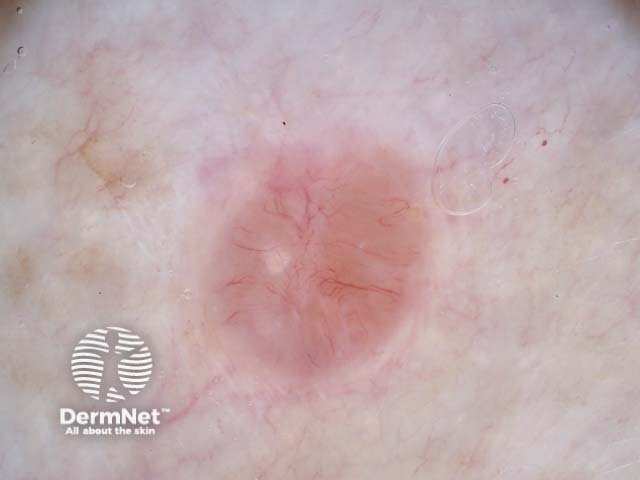 Nodular basal cell carcinoma dermoscopy