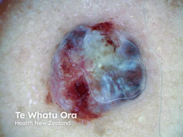 Nodular basal cell carcinoma, polarised dermoscopy view