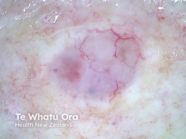 Nodular basal cell carcinoma, nonpolarised dermoscopy view