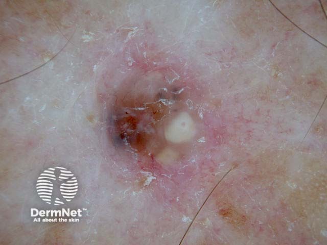 Nodular basal cell carcinoma dermoscopy