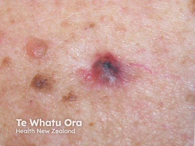 Nodular basal cell carcinoma