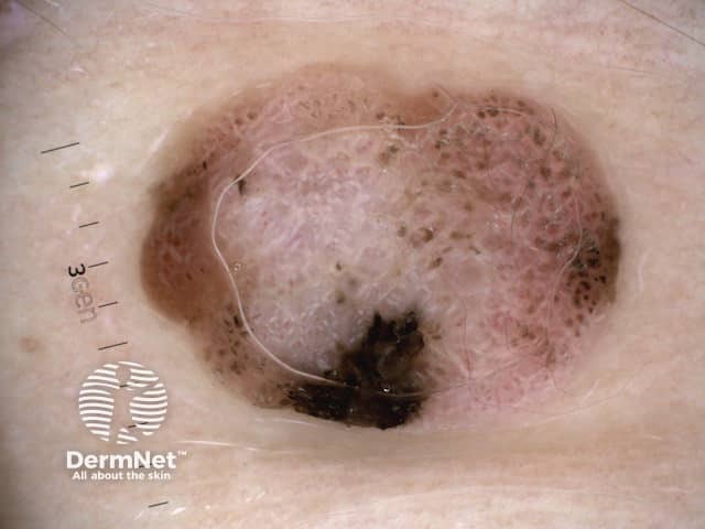 Nodular melanoma, Breslow 2.5 mm, polarised dermoscopy view