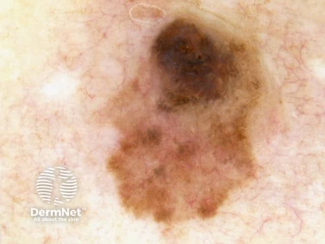 Dermoscopy of nodular melanoma arising within a superficial spreading melanoma