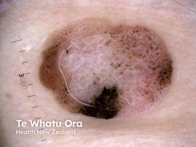 Nodular melanoma