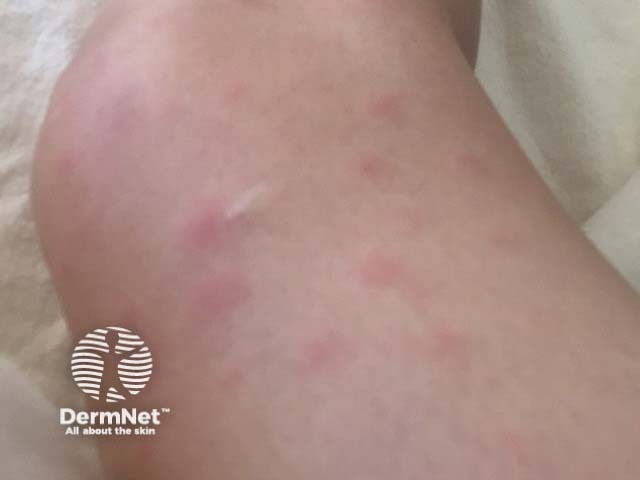 Nodular panniculitis