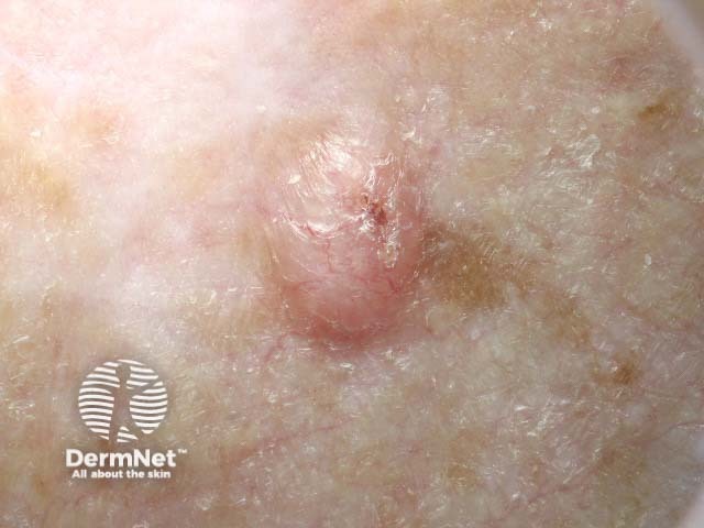 Basal cell carcinoma