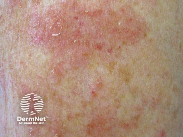 Nummular dermatitis