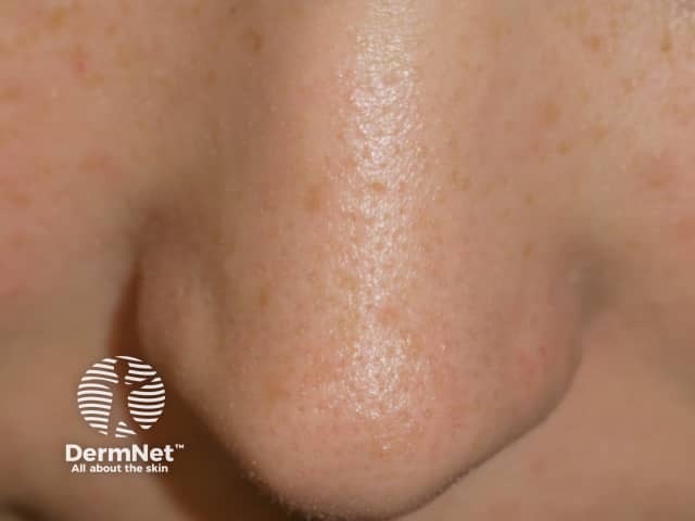 Enlarged pores