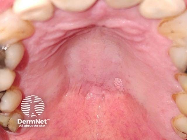 Oral squamous cell papilloma