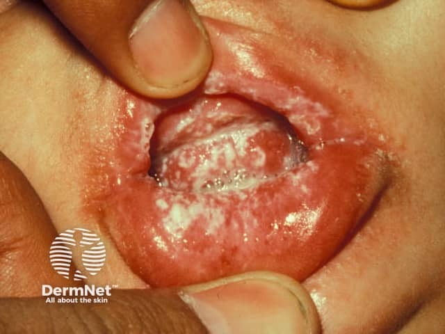 Oral thrush in a baby