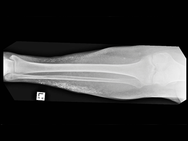 Acquired plate-like osteoma cutis