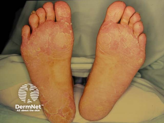 Plantar keratoderma