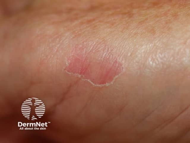 Circumscribed palmar hypokeratosis