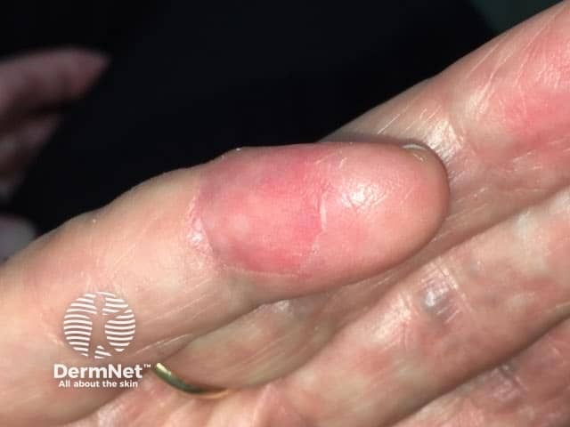 Circumscribed palmar hypokeratosis