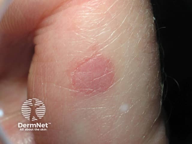 Circumscribed palmar hypokeratosis