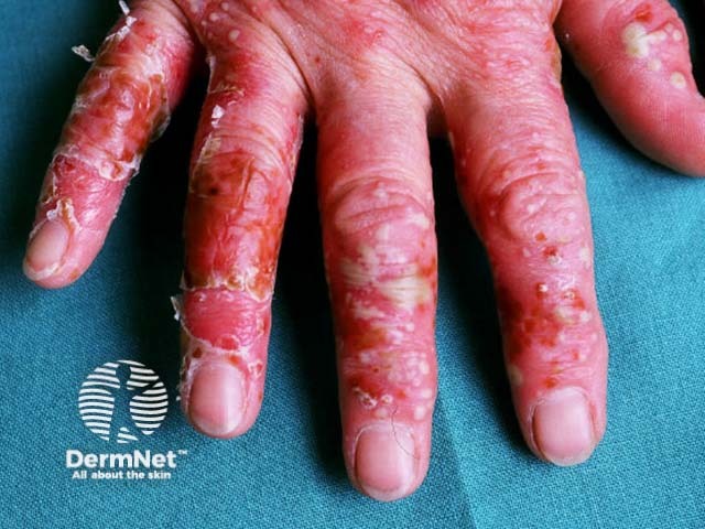 Palmar pustulosis