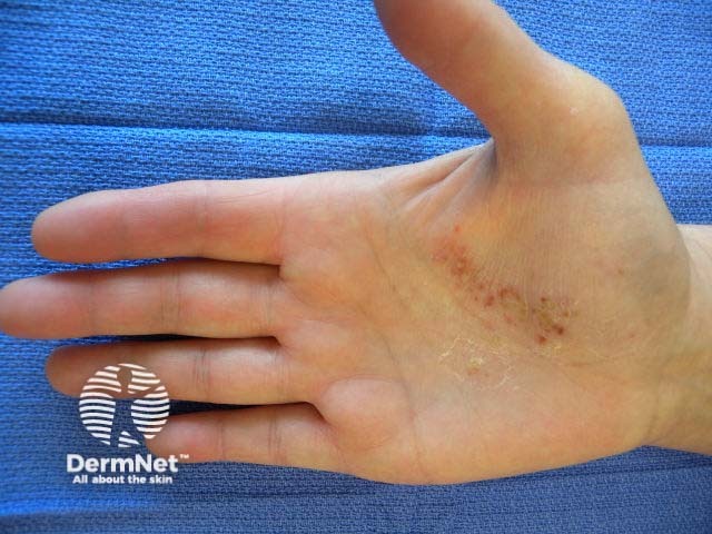 Palmar pustulosis