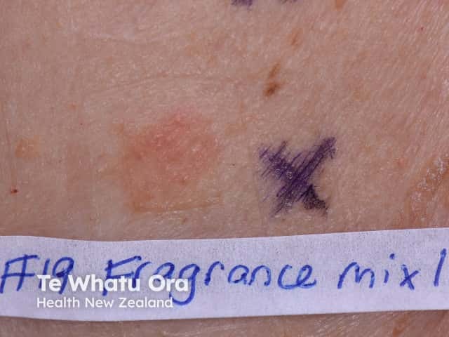 Positive patch test to fragrance - fragrance mix I