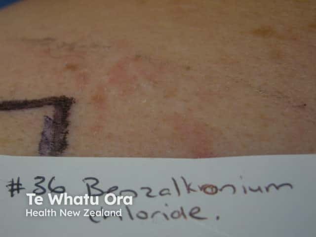 Borderline patch test reaction to benzalkonium chloride