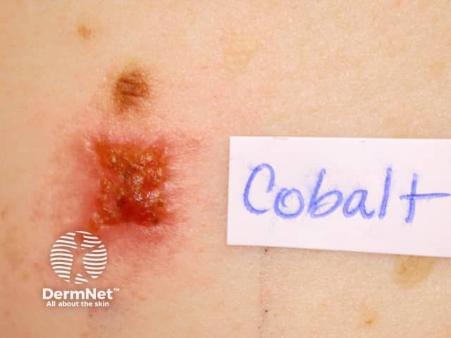 Positive patch test to cobalt