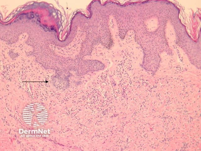 Pathology of dermatofibroma