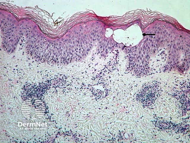 Spongiotic eczema